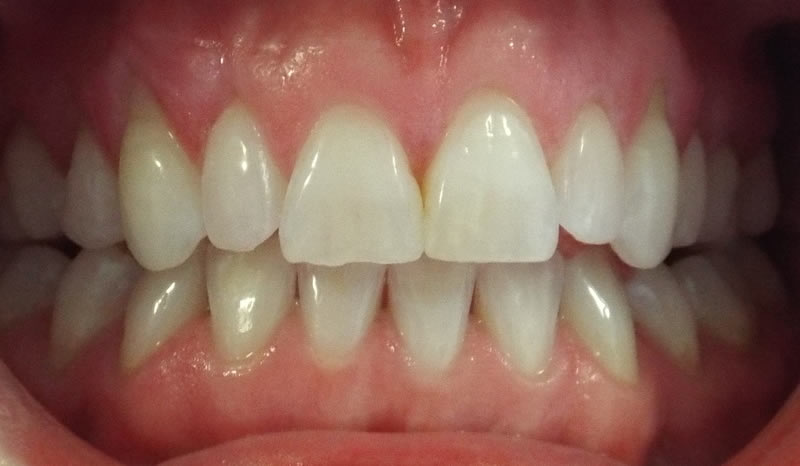tooth whitening in douglas cork