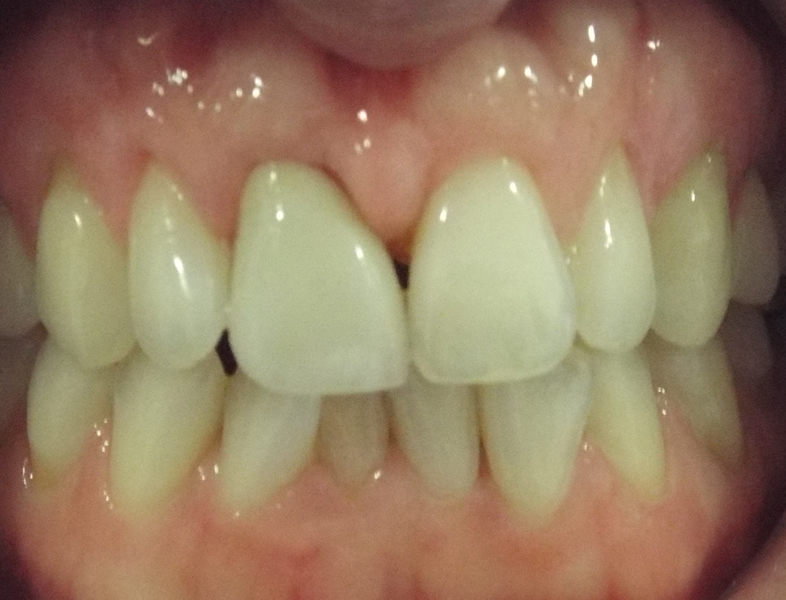 crown and whitening 