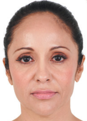 anti-wrinkle injectionstreatment - after anti-wrinkle injections treatment