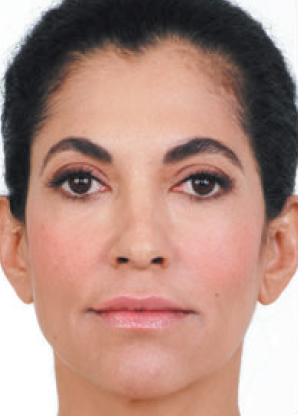 anti-wrinkle injections treatment - after anti-wrinkle injections  treatment