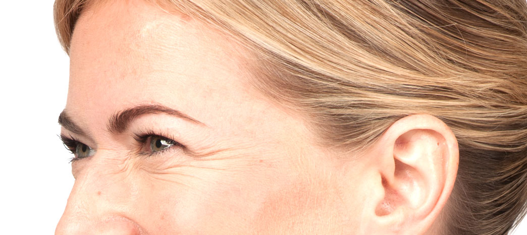 anti-wrinkle injections treatment - before anti-wrinkle injections treatment