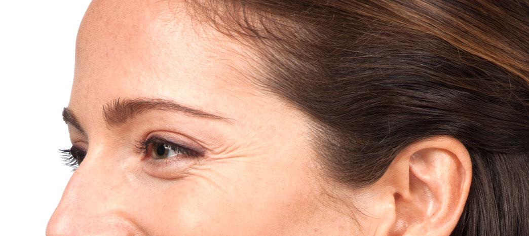 anti-wrinkle injections treatment - before anti-wrinkle injections treatment