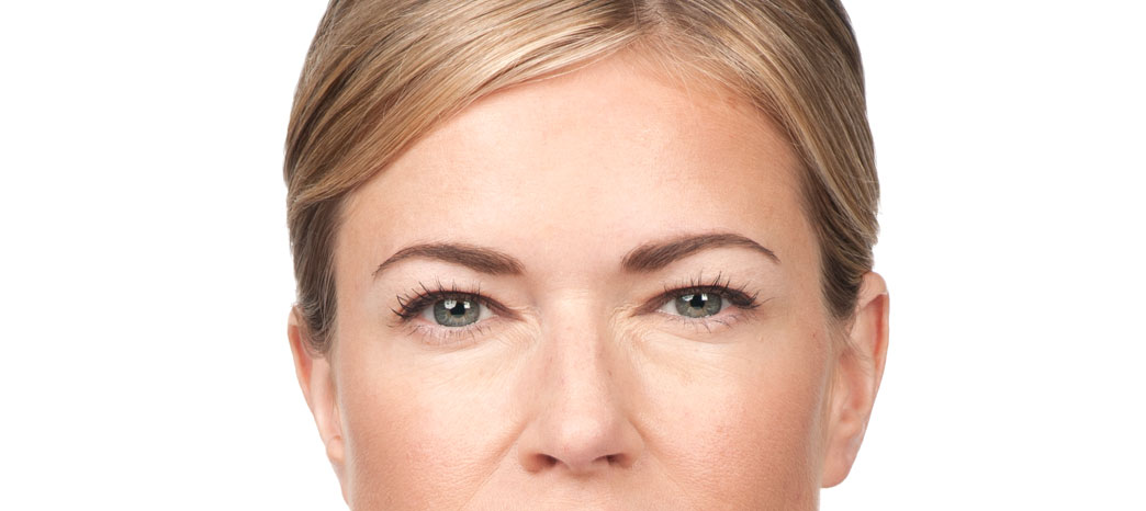 anti-wrinkle injections treatment - after anti-wrinkle injections treatment