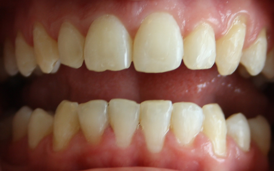 six month smiles adult orthodontics